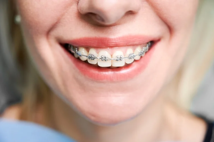 Ortopedia Facial dos Maxilares - Funcional e Mecânica